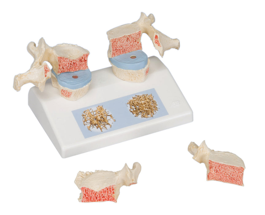 3B Scientific A95 Anatomical Model - Osteoporosis Model - Includes 3B Smart Anatomy