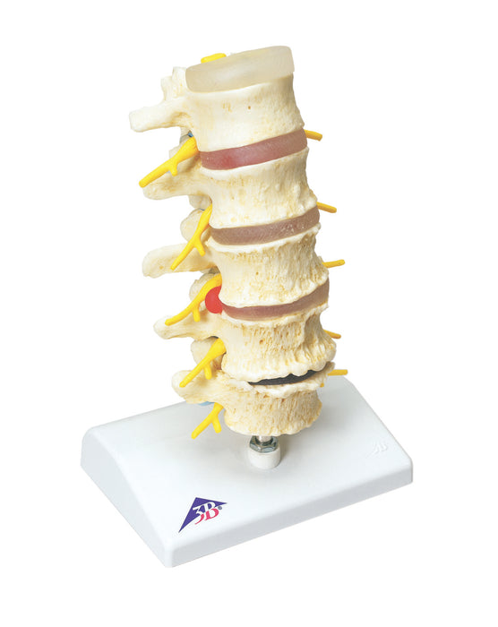 3B Scientific A795 Anatomical Model - Vertebrae Degeneration, Stages Of Prolapsed Disc - Includes 3B Smart Anatomy