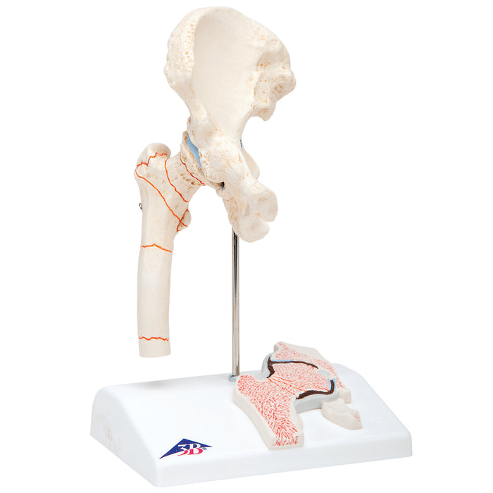 3B Scientific A88 Anatomical Model - Femoral Fracture And Hip Osteoarthritis - Includes 3B Smart Anatomy