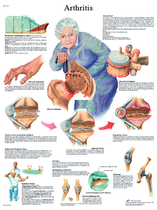 3B Scientific VR1123L (1-4) Anatomical Chart - Arthritis, Laminated