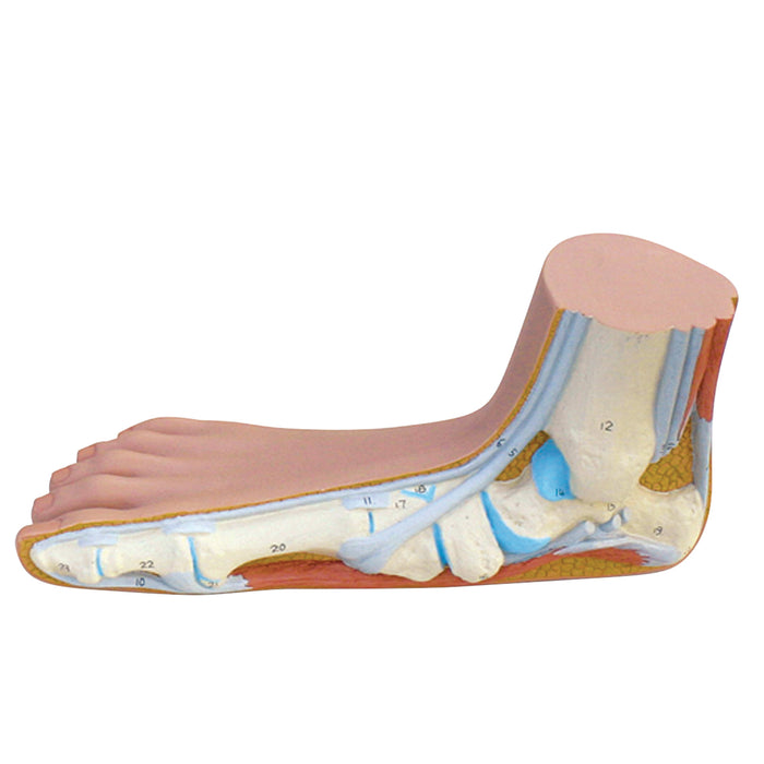 3B Scientific M31 Anatomical Model - Flat Foot (Pes Planus) - Includes 3B Smart Anatomy