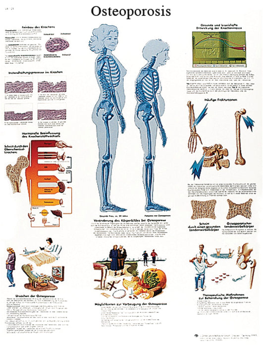 3B Scientific VR1121UU (1-4) Anatomical Chart - Osteoporosis, Paper